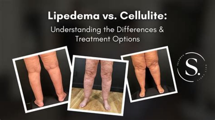 Does vinegar get rid of cellulite?