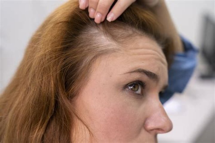 Does vinegar open hair follicles?
