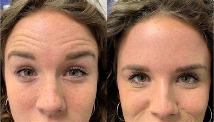 How can I get rid of deep forehead wrinkles without Botox?