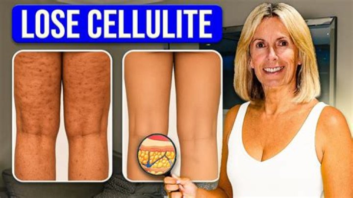 How can I make my cellulite less visible?