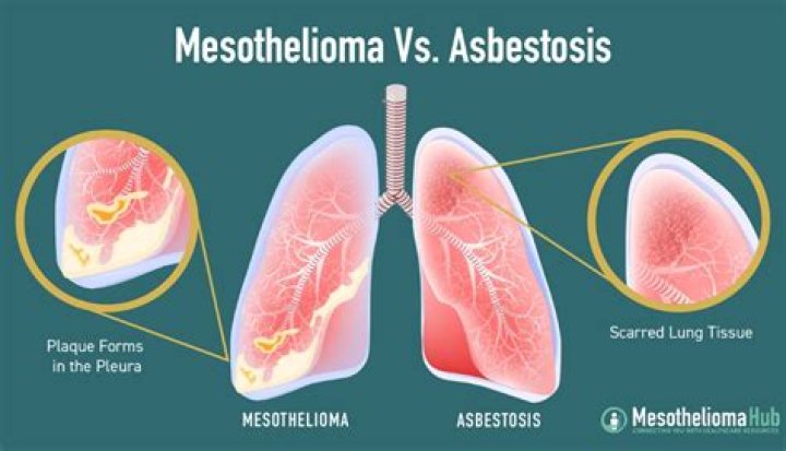 How can you prevent mesothelioma after asbestos exposure?