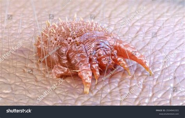 How did I get scabies?
