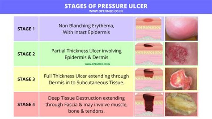 How do doctors tell if you have an ulcer?