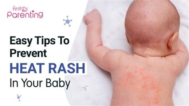 How do I deal with heat rash?