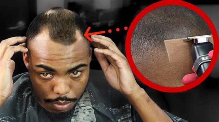 How do I fix a bald spot on my head?