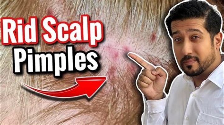 How do I get rid of crusty build up on my scalp?