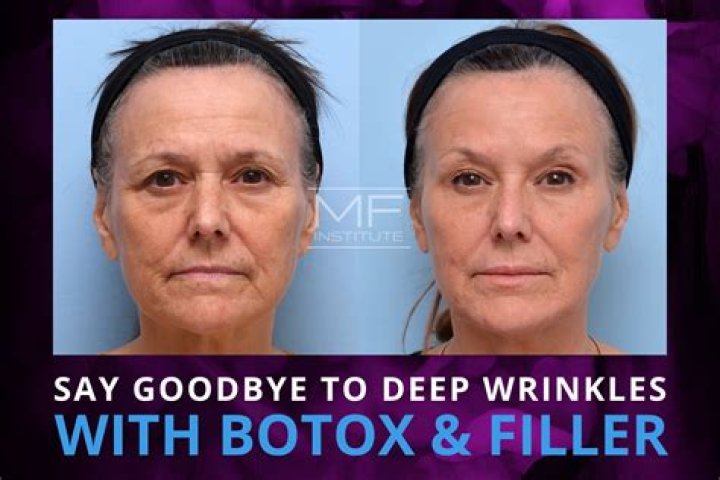 How do I get rid of deep wrinkles?