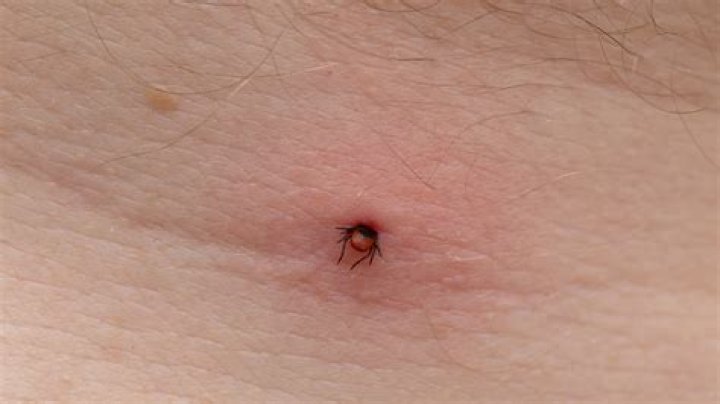 How do I know if I have a tick bite?