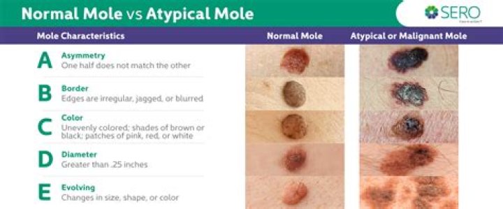 How do I know if I have freckles or melanoma?