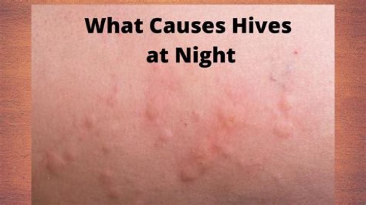 How do I stop hives from itching at night?