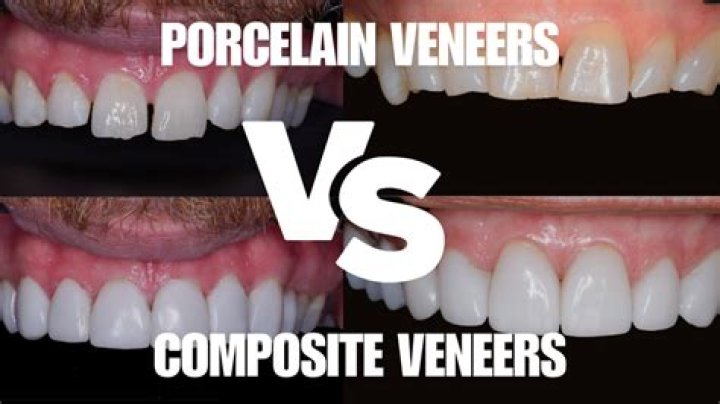 How do I stop my veneers from staining?