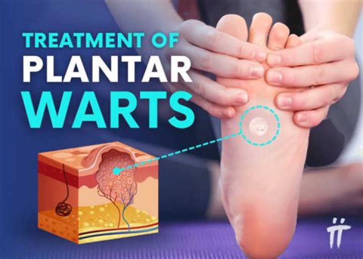 How do podiatrists remove plantar warts?