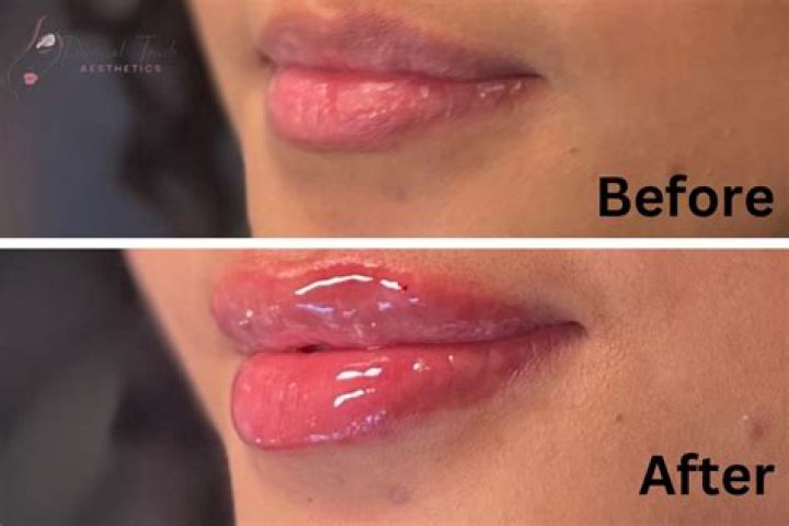 How do Russians get flat lips?