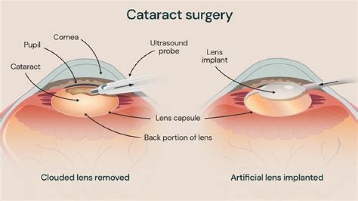 How do they remove cataracts without surgery?