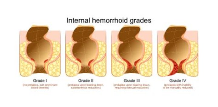 How do u pop a hemorrhoid?