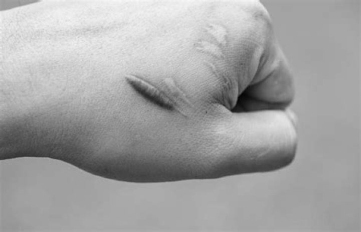 How do you fade scars fast?