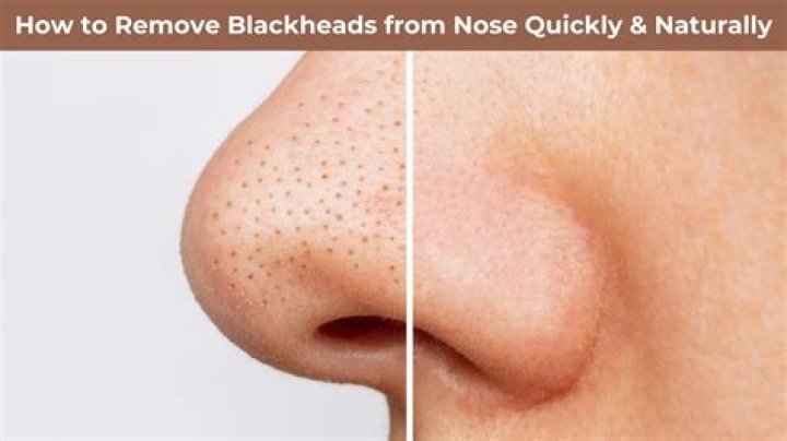 How do you get rid of blackheads with honey at home?