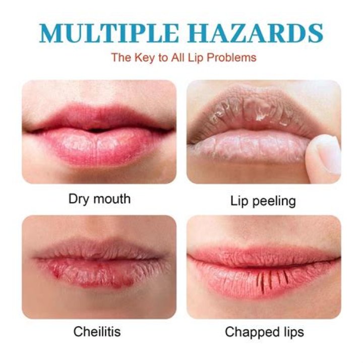 How do you get rid of chapped lips in 5 minutes?