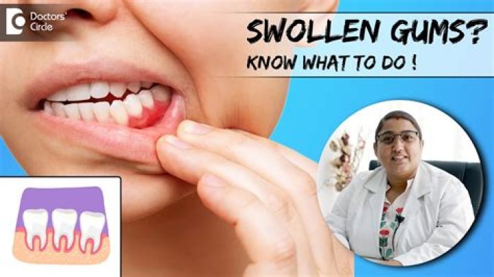 How do you get rid of swollen gums fast?