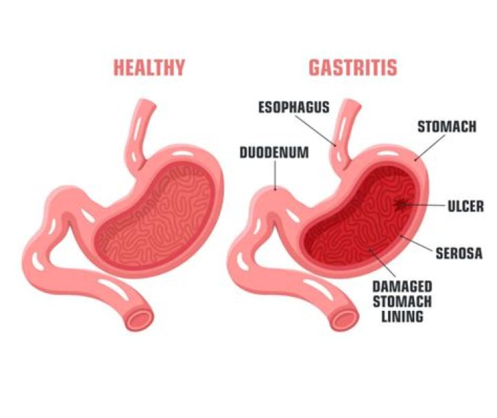 How do you heal stomach lining after gastritis?