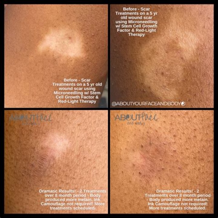 How do you hide Hypopigmented scars?