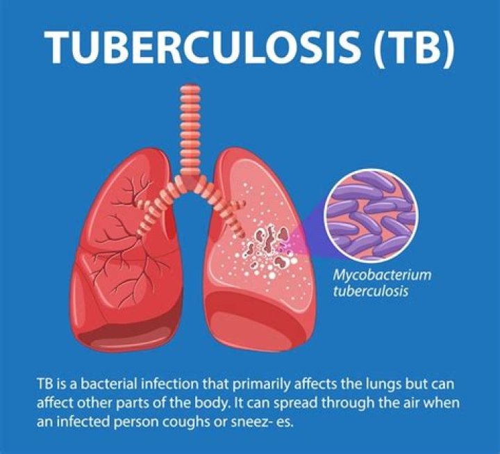 How do you look when you have tuberculosis?