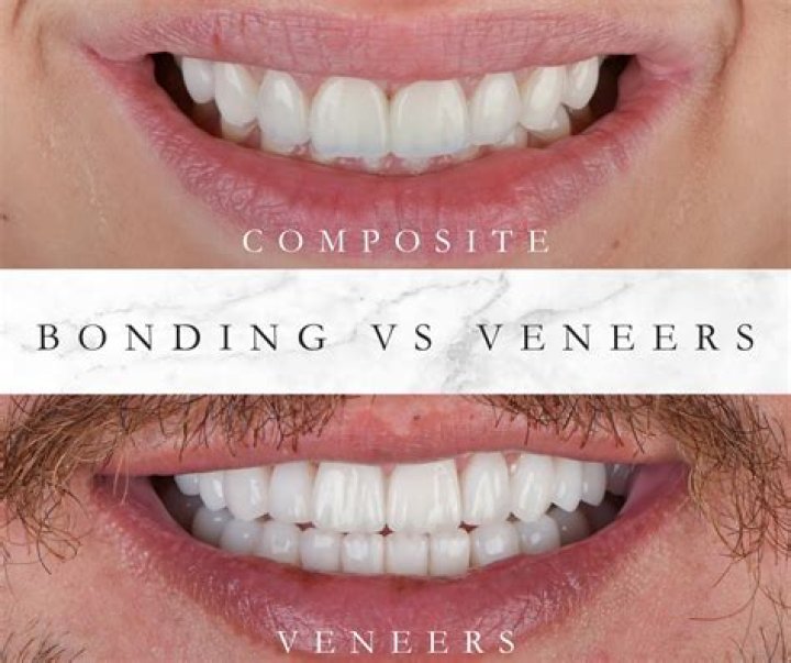 How do you maintain composite veneers?
