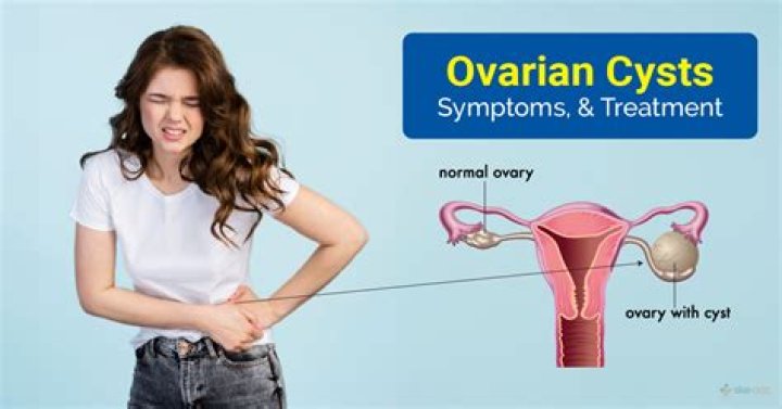 How do you prevent ovarian cysts?