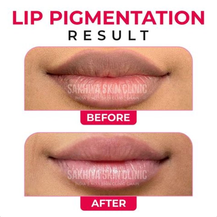 How do you treat lip pigmentation?