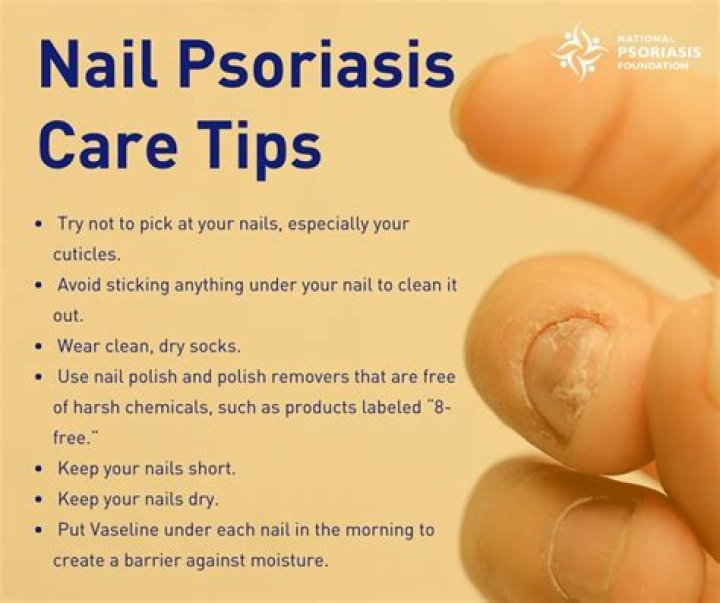 How do you treat psoriasis of the nails?