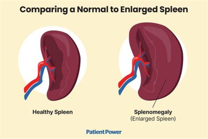How do you treat spleen pain?