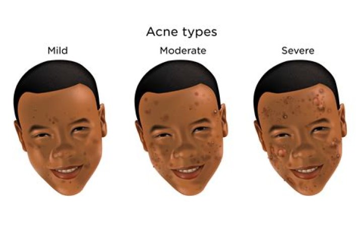 How does Jungkook get rid of acne?