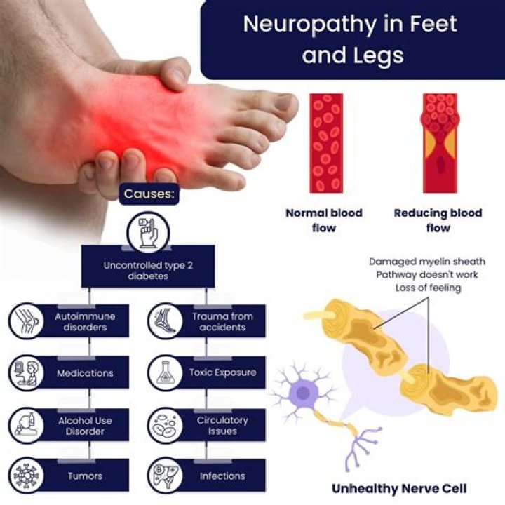 How far can neuropathy spread?