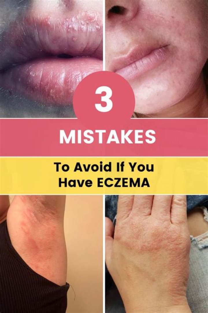 How I cured my eczema naturally?