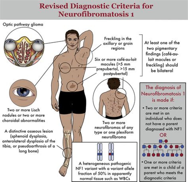 How is neurofibroma diagnosed?