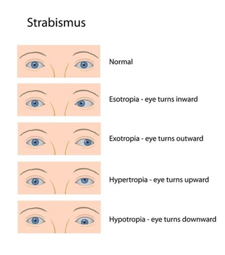 How is strabismus diagnosed?