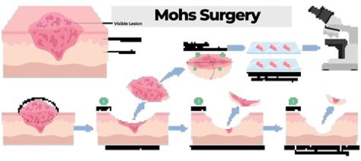 How long after Mohs surgery can I drink?