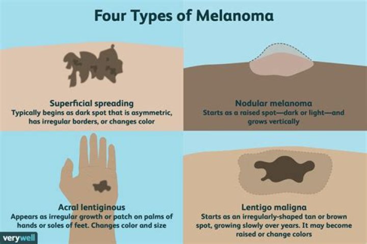How long can melanoma go untreated?