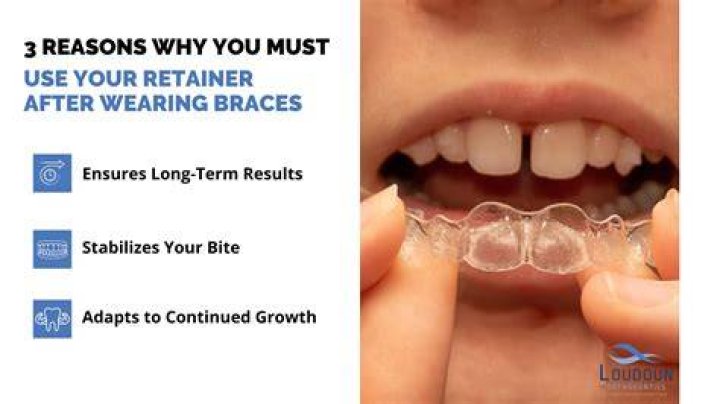 How long can you go without a retainer after getting braces off?