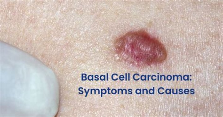 How long can you leave basal cell carcinoma untreated?