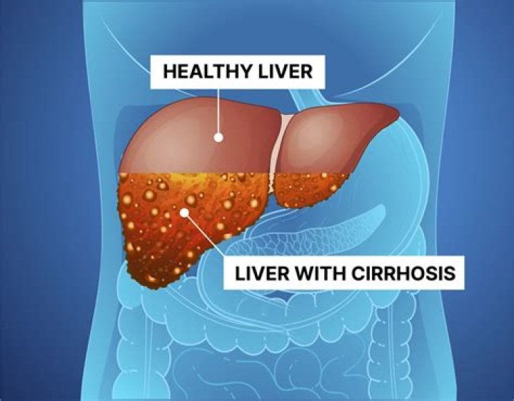 How long can you live with Stage 1 cirrhosis?