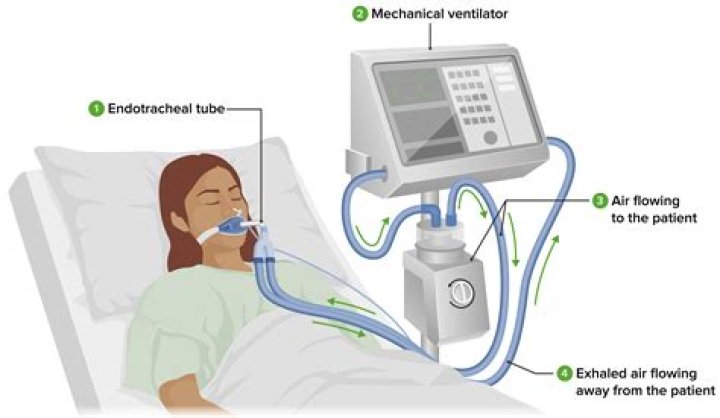 How long can you stay on a ventilator?