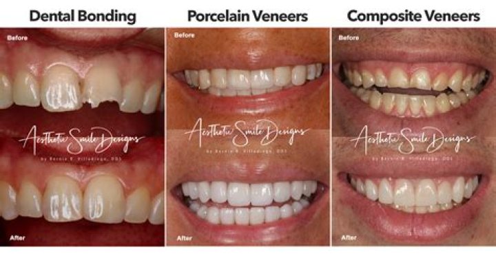 How long do veneers take to put on?