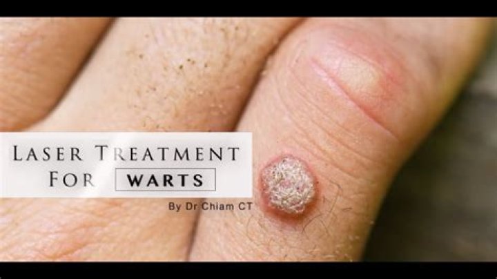 How long do warts take to go away?