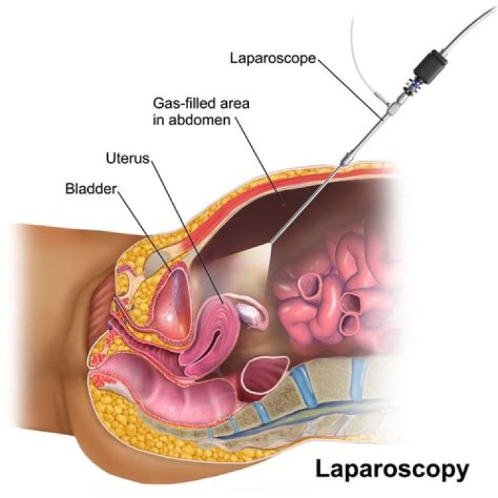 How long does a laparoscopy take for endometriosis?