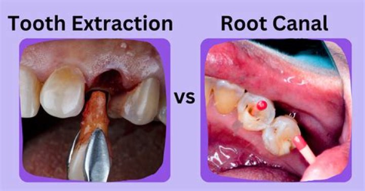 How long does a tooth last after a root canal?