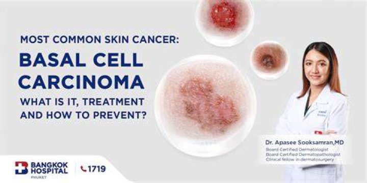 How long does basal cell carcinoma take to spread?