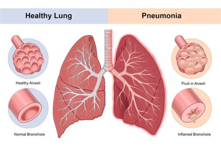 How long does it take for COVID pneumonia to clear up?