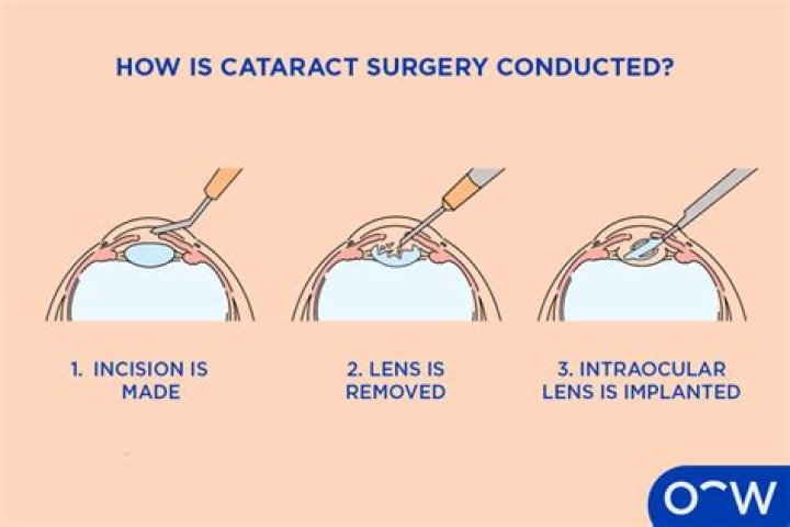 How long does it take for the brain to adjust to cataract surgery?