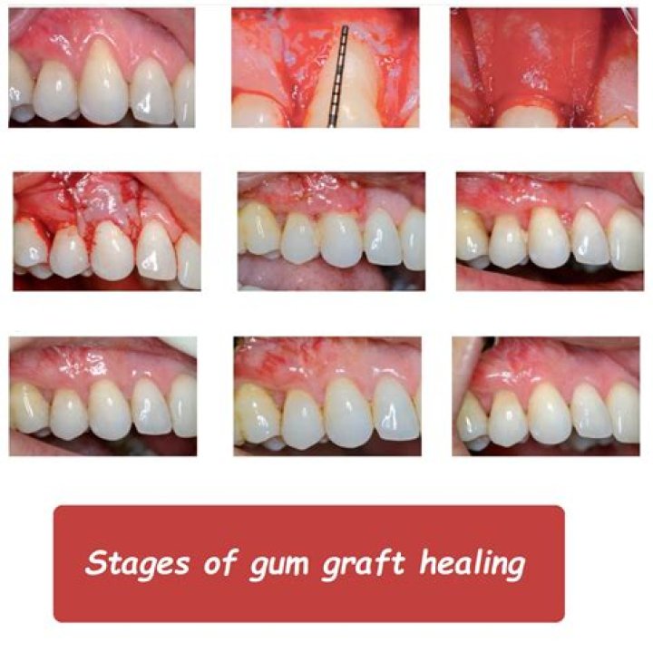 How long does it take for your gums to heal after having all your teeth pulled?
